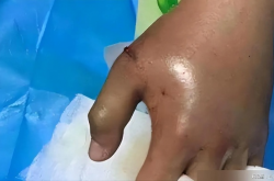 女子放羊休息时突遭蛇咬，疼痛难忍当场泪流满面